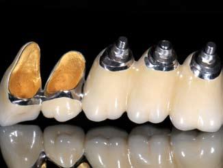 des Kausystems Allgemeine Einführung Indikationsklassen der Implantologie spezielle anatomische Kenntnisse für die Implantation Systemübersicht von Zahnimplantaten Gerostomatologie Planung der