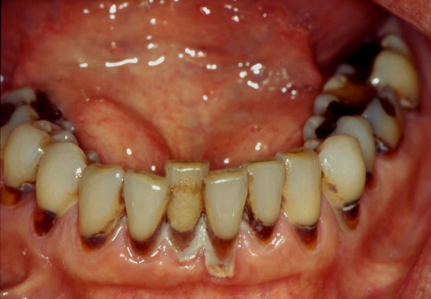 2. Der alternde Mund Wurzelkaries Die Wurzelkaries (nach Rückgang des Zahnfleisches) kommt bei älteren Patienten häufig vor und ist