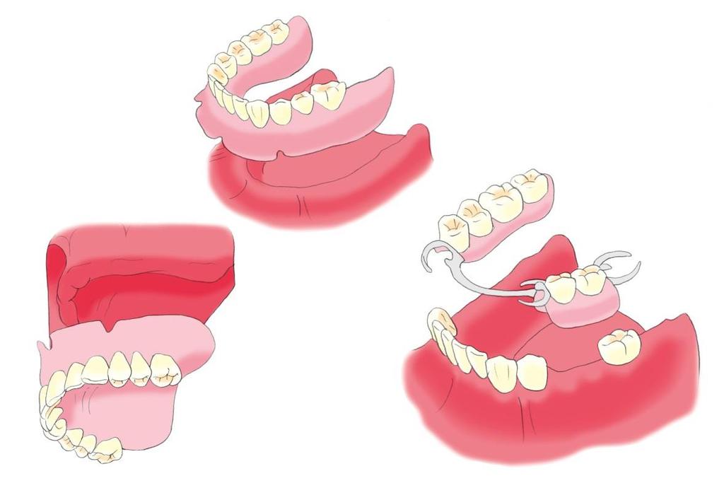 2. Der alternde Mund Zahnprothesen Viele älteren Personen tragen Zahnprothesen, entweder