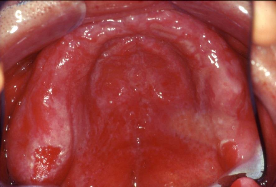 Gaumen und Zunge rötliche Läsionen Infektionen im