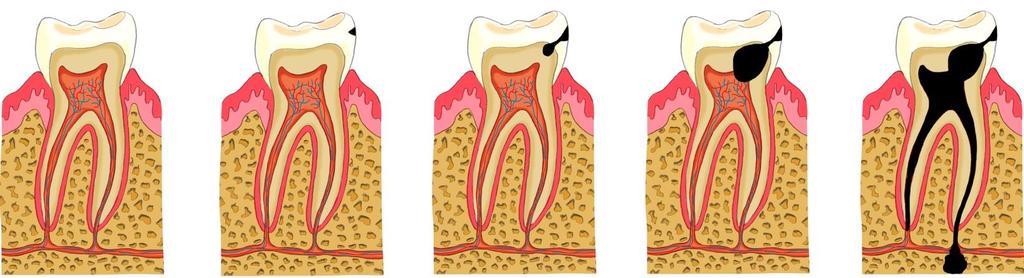 1. Pathologien der Zähne Karies Prozess der Kariesentstehung : Aufnahme von Zucker Umwandlung in Säuren durch Bakterien des Zahnbelages Entkalkung des Schmelzes durch die Säuren Entstehung einer