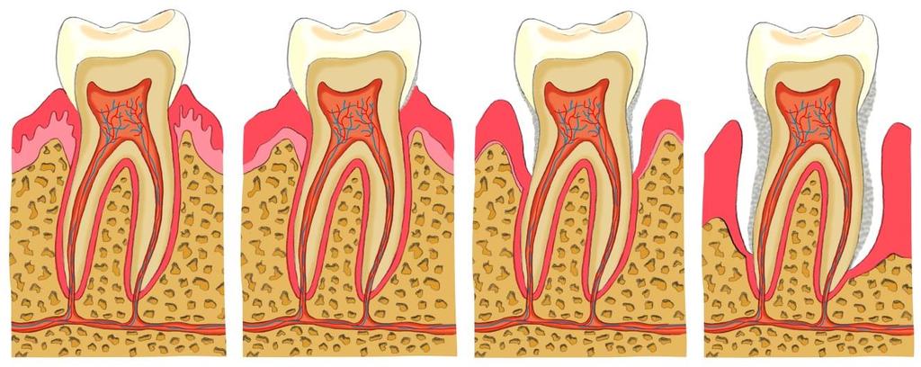1. Pathologien der Zähne Gingivitis / Parodontitis Entstehung von Gingivitis und Parodontitis : Vorhandensein von Plaque (Zahnbelag) Entzündung des Zahnfleisches = Gingivitis (Rötung, Schwellung,