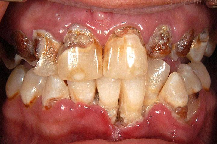 1. Pathologien der Zähne Zusammenfassung