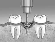 In unserer Praxis bieten wir seit vielen Jahren erfolgreich Zahnersatz durch Implantate an, die fest im Kno chen verankert werden.