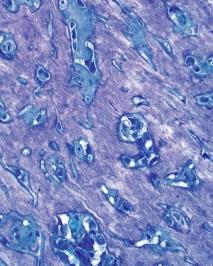Tumormatrix, in der nur wenige Tumorzellen eingeschlossen sind (links oben) osteoblastisches