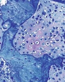 Matrix (links unten) teleangiektatisches Osteosarkom mit schmalen Septen aus Tumorzellen und