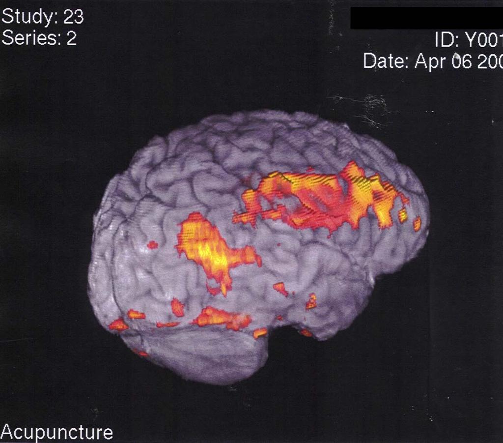 Erkenntnisse aus der Neurowissenschaft zur Kommunikationswirkung 45 Abbildung 6: Darstellung aktiver Hirnareale mit der Neuro-Imaging-Methode Quelle: Frtcm (2012) Es ist heute und wahrscheinlich auch