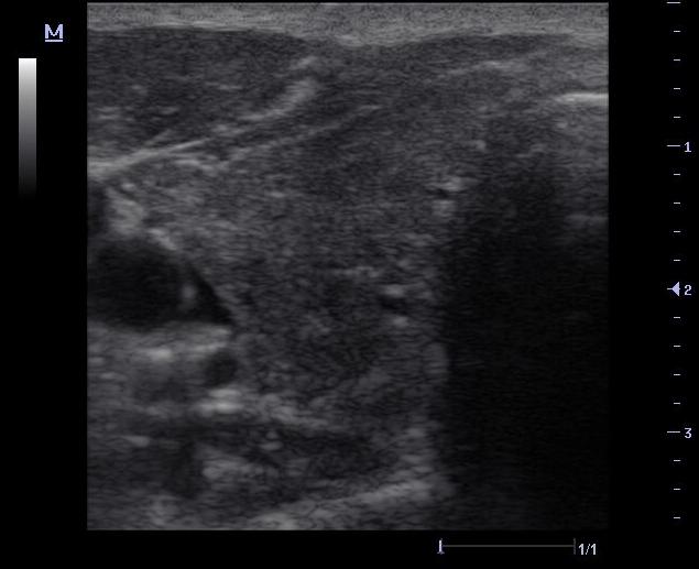 Schilddrüsen-Sonografie Folie 29