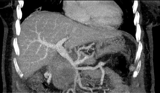 ERGEBNISSE 58 Abbildung 21: Koronare MPR: Tumorbedingte Stenose des portalvenösen Konfluens und der VMS (Pfeil) In vier Fällen bestand eine Thrombose des Konfluens, welche von beiden Untersuchern