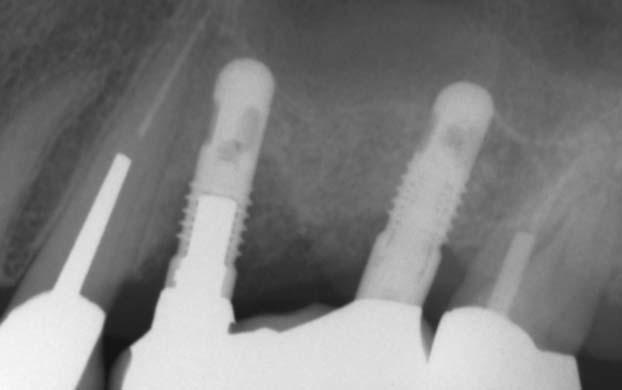 Zahnmedizin Implantologie vs. Konventionelle Therapien Anwenderbericht Abb. 8: Kontrolle des Knochenniveaus nach Wiedereingliederung der Brücke. Abb. 9: Eingesetzte Brücke mit geringem Verlust des periimplantären Weichgewebes.