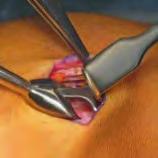 Es kann nun die Sehnenstanze zur endständigen subkutanen Durchtrennung der Sehne am proximalen Sehnenende von lateral eingeführt