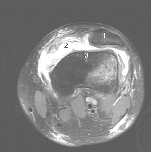 Abbildung 7: Axiales Magnetresonanztomographie-Schnittbild auf dem die Trochlea erstmals komplett mit Knorpel überzogen ist.