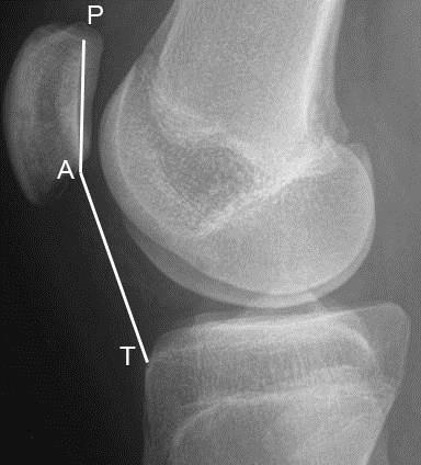 Abbildung 10: Bestimmung der Patellahöhe durch den Caton-Deschamps-Index im seitlichen Röntgenbild. Bestimmung der Strecke AT und AP.