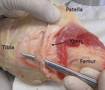 Abbildung 1: Foto einer Präparation des MPFL (mediales patellofemorales Ligament) an einem anatomischen Präparat eines Kniegelenkes.