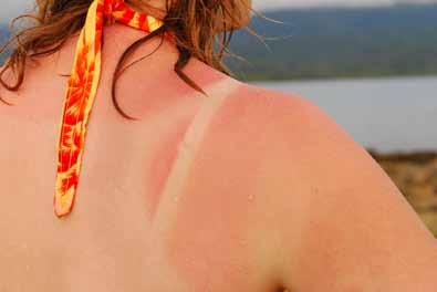 Die Sonne, der FEIND führt zum Sonnenstich oder zu schmerzhaften Sonnenbränden fördert die vorschnelle Alterung der Haut legt den Grundstein für Hautkrebs.