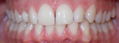 Allein oder kombiniert. Flexibilität ermöglicht einfache Integration. Invisalign Go kann als eigenständige Behandlung zur Zahnbegradigung eingesetzt werden.