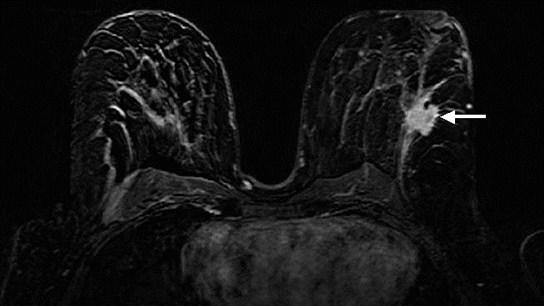 Mammakarzinom Typischer Befund in der MR Mammographie: Fokale KM Anreicherung ODER ringförmiges