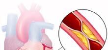 PREDIMED Studie: CVD Herz-Kreislauf-Inzidenz (acute myocardial infarction,