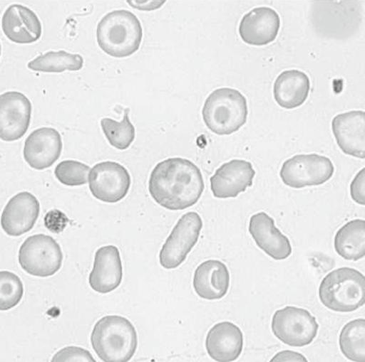 .6 Hämoglobinopathien 69 a b Abb..1 a Erythrozytenmorphologie bei β-thalassaemia major: Targetzellen, Mikrozytose, Anisozytose.