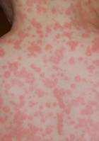 Nesselgift in den Brennhaaren Thaumetopoein ist ein auf Eiweißbasis aufgebautes Nesselgift, das u.a. allergische Reaktionen hervorruft.