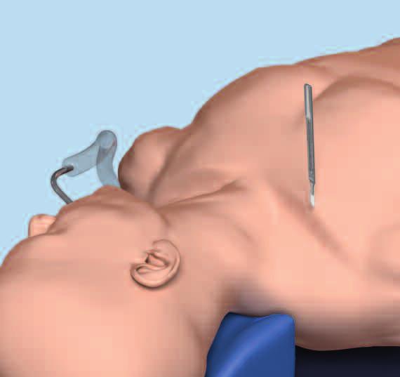 Implantation: Offener Zugang 1 Chirurgischer Zugang (offen) Parallel zu den Hautspaltlinien eine leicht gebogene Inzision anlegen.