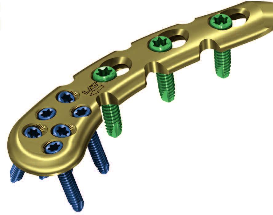 4 mm Kortikalisschrauben Rekonstruktionsplatten - segmente ermöglichen, falls erforderlich, Konturierung der Platte Unterschnitte