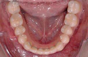 Attachments sowie die gute Durchgängigkeit der Zahnzwischenräume überprüft und gegebenenfalls Approximale
