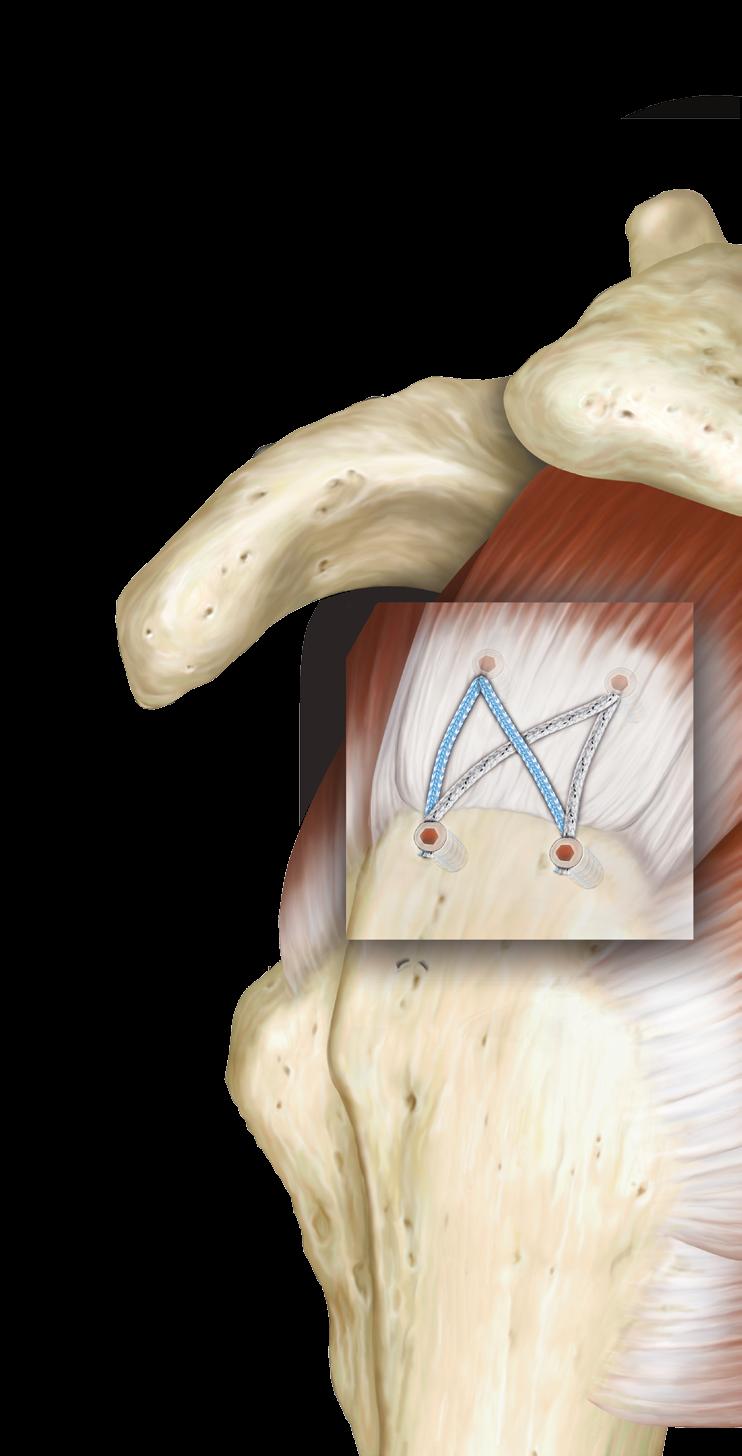 Anpressdruck dank 2 mm FiberTape Großflächiger Sehnen-Knochenkontakt Kein Durchschneiden des Gewebes Hohe