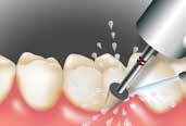 Restauration und einem geeigneten Dentin- / Schmelzbond (Futurabond U)