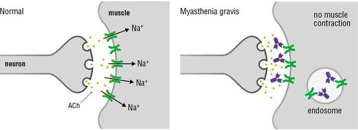 Myasthenia Gravis Antikörper gegen AchR: Störung der neuromuskulären Signal-Übertragung Klinik Variabilität Okulär: Ptosis, Diplopie Systemisch: Ermüdung, Dysphagie, Dysarthrie,