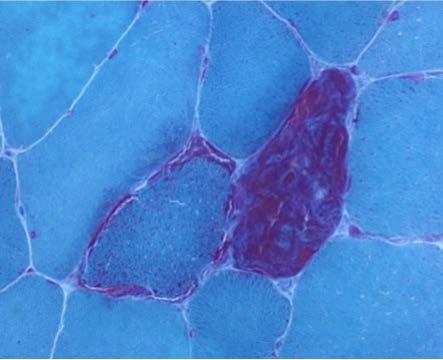 Mitochondriale Myopahtie mt-dna Mutation (Atmungskette) Zellen mit hoher Mitochondrien-Dichte extra-okuläre Muskeln, Gesichtsmuskulatur, etc. Klinik: CPEO: KSS: Paraklinik: Labor: chron.