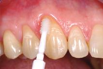 Zahnhälsen wurden 25 Patienten mit einem Placebo-Lack und 25 Patienten mit VivaSens