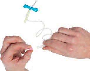 1. Nehmen Sie die Kappe am Ende des Venenpunktionsbestecks ab, wo die Injektionsspritze mit aufgelöstem