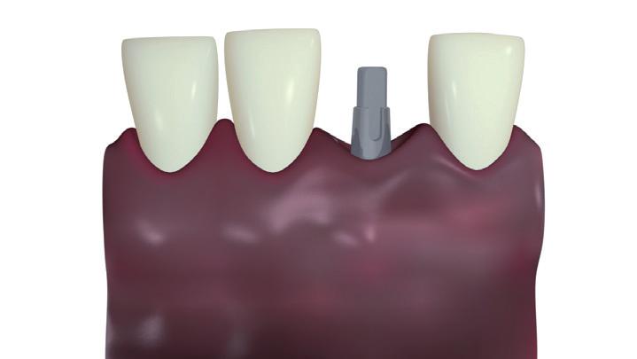 implantate Schonende Implantation dank MIMI Minimalinvasive Methode der Implantation Implantate - das sind künstliche Zahnwurzeln, die einen optimalen Halt für Zahnersatz bieten.