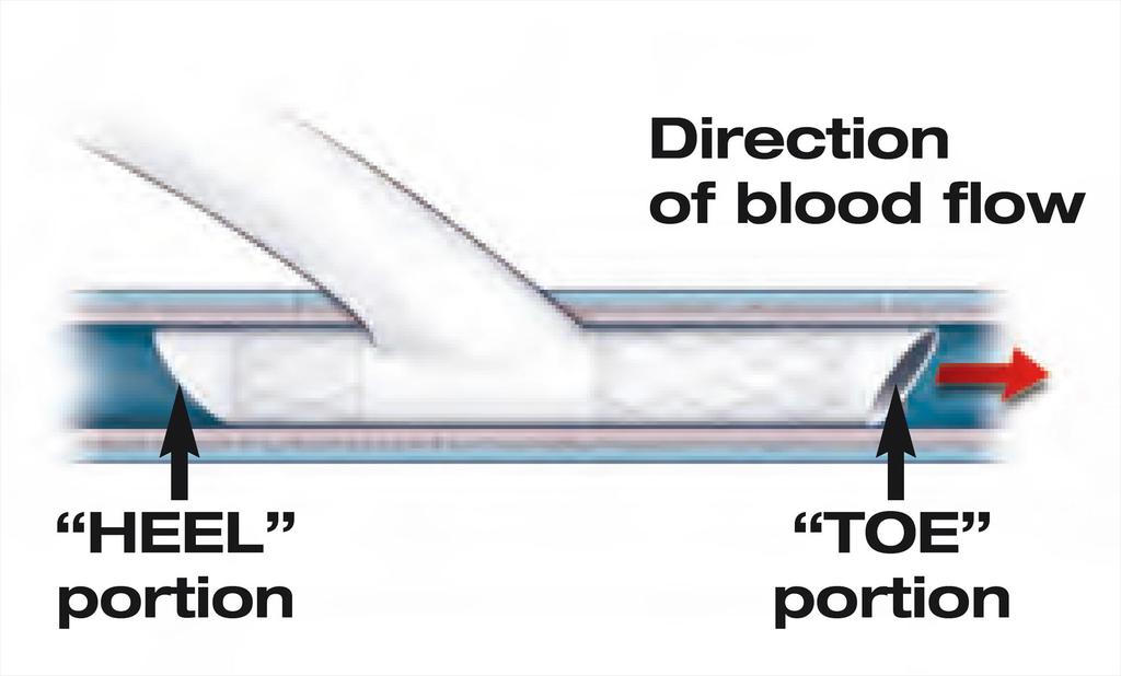 T-Konfiguration Implantation in die Ausstrombahn keine reguläre venöse