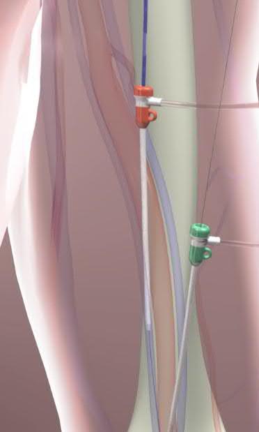 Endovaskuläre Katheter-basierte AVF Perkutan Vorteile Kein Implantat Kein Einschnitt - Reduktion der Wundinfektionen und Komplikationen Erleichtert die AV-Fistel Platzierung von interventionellen und