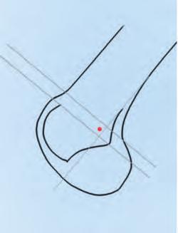 posteriorsten Punkt der Blumensaat schen Linie liegt (Abb. 14a d) 34 35. a c 14 Korrekte Positionierung der femoralen Insertion im streng seitlichen Röntgenbild (a, b).