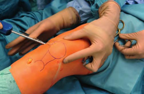 1 mm größer als der Transplantatdurchmesser gewählt. Das Bohrloch wird vom umgebenden Gewebe debridiert, um ein problemloses Einziehen des Transplantates zu gewährleisten.