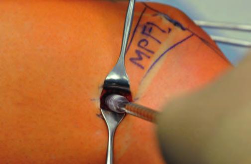 Operationstechnik: Die anatomische Rekonstruktion des Ligamentum 13 Beim Eindrehen der Schraube ist darauf zu achten, dass sich das Transplantat nicht um die Schraube dreht.