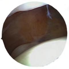 In der Gilquistposition, bei der das Lichtleiterkabel nach unten gedreht wird, kann der laterale Überhang der Patella in Referenz zur Begrenzung des lateralen Femurkondylus gut beurteilt werden (Abb.