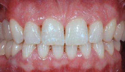 Bleaching-Schienen, die wir gerne für Sie herstellen, können Sie Ihre Zähne schonend und einfach