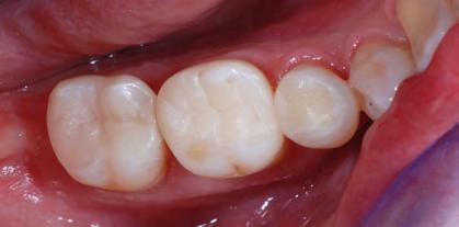 Sie werden sehr lange Freude an Ihren schönen neuen Zähnen haben!