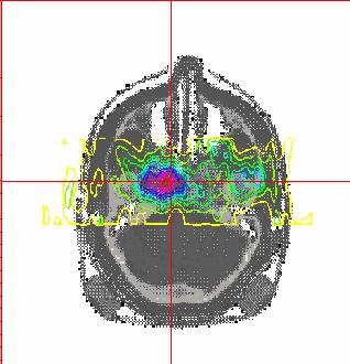 Lokale β + -Aktivität um das rote Fadenkreuz beim Beschuss eines Gehirntumors mit hochenergetischen 12 C 6+ -Ionen (GSI Darmstadt) Kurz vor dem Abstoppen der 12 C Ionen (400 MeV/amu) im Gehirntumor