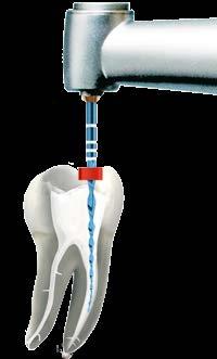 Studien belegen nun klar, dass die schallbasierte Aktivierung der Spülflüssigkeiten zu einer signifikanten Verbesserung der endodontischen Behandlung führt.