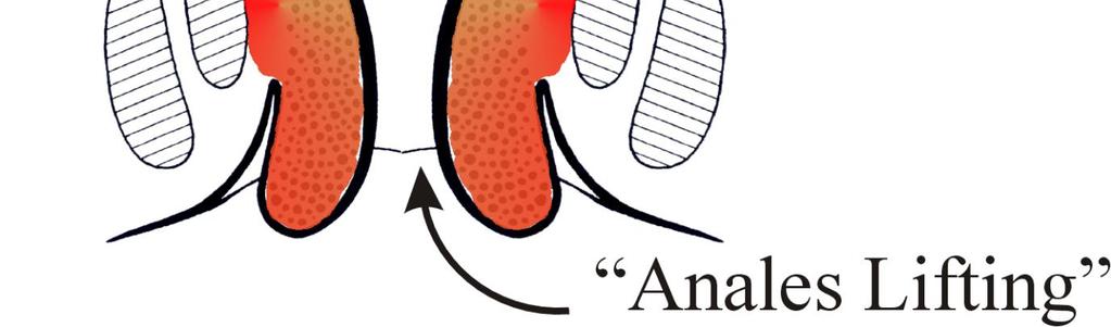 Hämorrhoidalschwellkörper unterbunden Die Entfernung der Schleimhautmanschette führt zu einem sogenannten analen Lifting, bei dem der vorgefallene