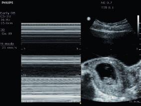 Ultraschalluntersuchungen direkt im Sprechzimmer In der Geburtshilfe verlassen Sie sich auf den einfachen Zugriff auf Ultraschallbilder mit diagnostischer Qualität, damit Sie allen Patientinnen eine