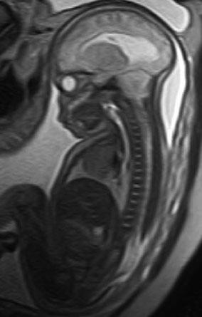 MRT kraniozervikaler Übergang (sagittal, T2): die MRT zeigt eine Elongation der Kleinhirntonsillen nach zervikal, begleitende