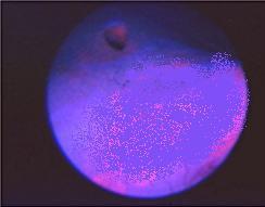 Fluoreszenz-Zystoskopiegeräte Kurzpass-Filter Langpass-Filter im Okular des Zystoskopes Farbkontrast zwischen roter Fluoreszenz der Neoplasie und des blau