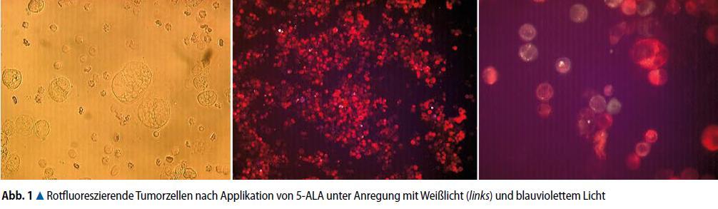 Zukunft: Fluoreszenzzytologie vielversprechende Weiterentwicklung der Urinzytologie Problem: Ex-vivo-Inkubation von Urothelzellen