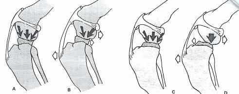 Literaturübersicht Die Abbildung 1 verdeutlicht schematisch die Druckverhältnisse für den medialen und lateralen Meniskus im kreuzbandintakten und kreuzbandinsuffizienten Kniegelenk.